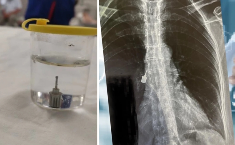 ФОТО: Жена на забар голтнала „клуч“- кога ја однеле на Ургентен лекарите се шокирале