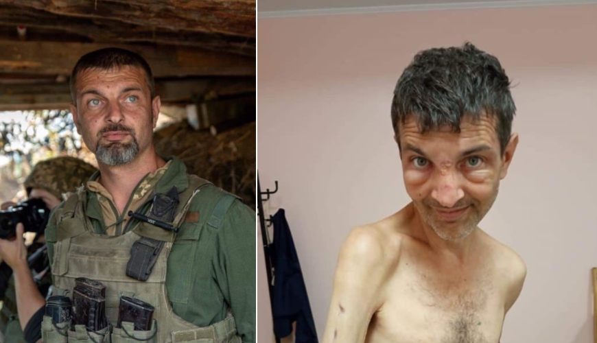 Му фалат 4 сантиметри коска: Објавени фотографии од украински војник ПРЕД и ПОСЛЕ руското заробеништво (ФОТО)